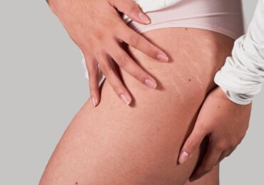 Stretch Mark Camouflage in Toronto: How It Works and What Results to Expect