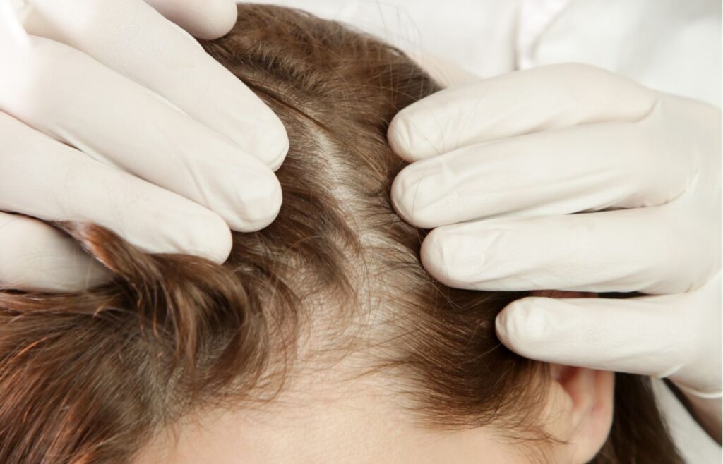 scalp microneedling toronto