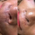 Camouflage tattoo after 2 sessions, in progress_