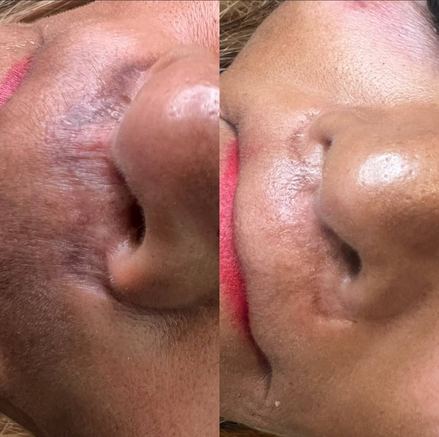 Camouflage tattoo after 2 sessions, in progress_