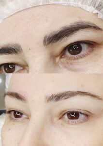 saline tattoo removal Toronto