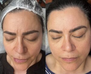 Facial-Mesoneedling (Microneedling) in Toronto
